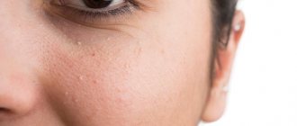 5 лучших способов избавиться от милиумов на лице