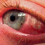 941700 - Ammonia got into the eye what to do