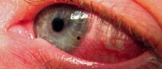 941700 - Ammonia got into the eye what to do