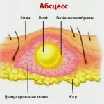 Abscess schematically