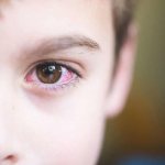 Аденовирусный конъюнктивит у ребенка