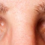 Аллергический конъюнктивит: лечение глазными каплями, симптомы, причины, МКБ-10