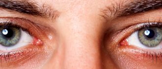 Аллергический конъюнктивит: лечение глазными каплями, симптомы, причины, МКБ-10