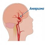 аневризма
