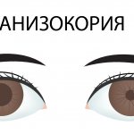 Анизокория пример