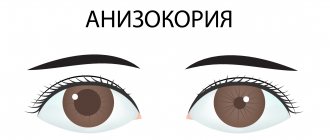 Анизокория пример