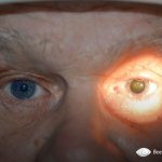 анизокория слева