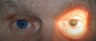 анизокория слева