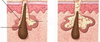 Белые точки под глазами. Что это такое, причины появления, как избавиться