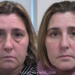 Безоперационная блефаропластика: все За и Против