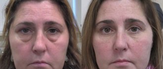 Безоперационная блефаропластика: все За и Против