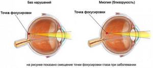Бифокальные (мульти) линзы для глаз контактные. Что это такое, как подобрать