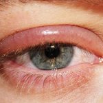 Блефарит — это воспалительный процесс, поражающий края век