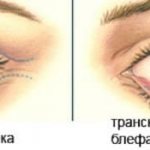 блефаропластика трансконъюктивальная