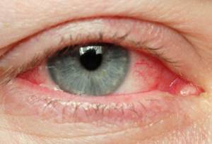 Болезнь глаукома