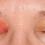 целлюлит века — это воспалительное заболевание век и кожи вокруг глаз