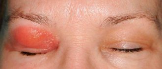 целлюлит века — это воспалительное заболевание век и кожи вокруг глаз