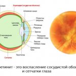 центральный хориоретинит