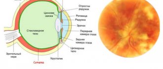 central chorioretinitis