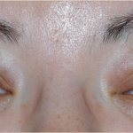 чем лечить отек и опухоль глаза