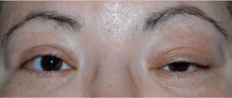 чем лечить отек и опухоль глаза