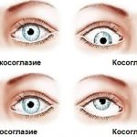 Black dots before the eyes. What are these spots, causes and treatment of blurred vision? 
