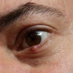 Чиряк под глазом