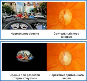 Что нужно знать про стадии глаукомы: признаки по которым определяют, можно ли сохранить зрение на каждом этапе