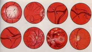 Atherosclerosis of retinal vessels - treatment and prognosis for recovery