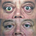 Что такое эндокринная офтальмопатия