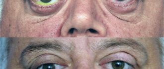 Что такое эндокринная офтальмопатия