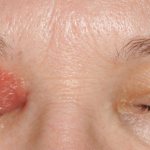 Что такое флегмона глазницы