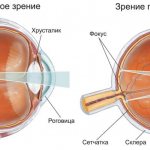 What is hypermetropic astigmatism - complex and simple