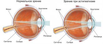 What is hypermetropic astigmatism - complex and simple