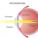 Что такое смешанный астигматизм обоих глаз