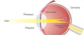 What is mixed astigmatism in both eyes?