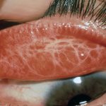 Что такое трахома глаз