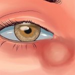 Дакриоцистит