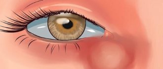 Dacryocystitis
