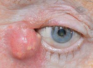 дакриоцистит - глазная болезнь