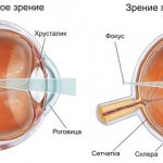 Дальнозоркость - как подобрать очки