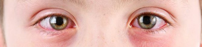 детский аденовирусный конъюнктивит глаз