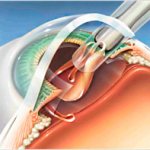 диагностика катаракты