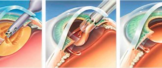 cataract diagnosis