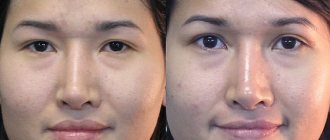 Before and after