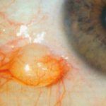 Доброкачественная киста конъюнктивы