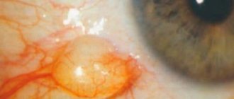 Benign conjunctival cyst