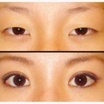 Двойное веко