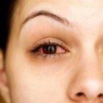 эписклерит глаза