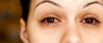 episcleritis of the eye